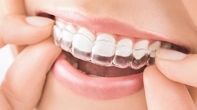 clear aligners to straighten teeth